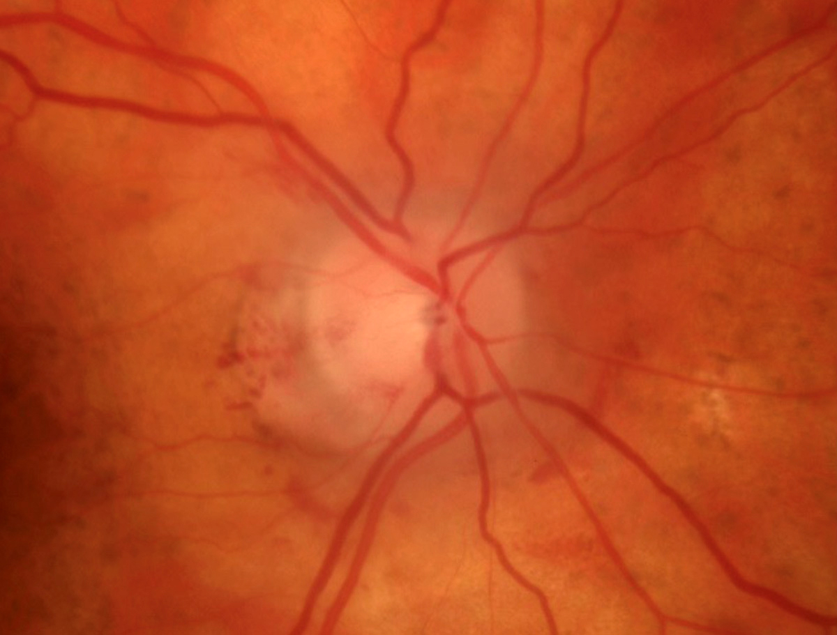 Anterior ischemic optic neuropathy