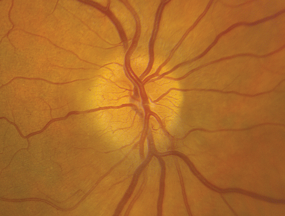 Anterior ischemic optic neuropathy