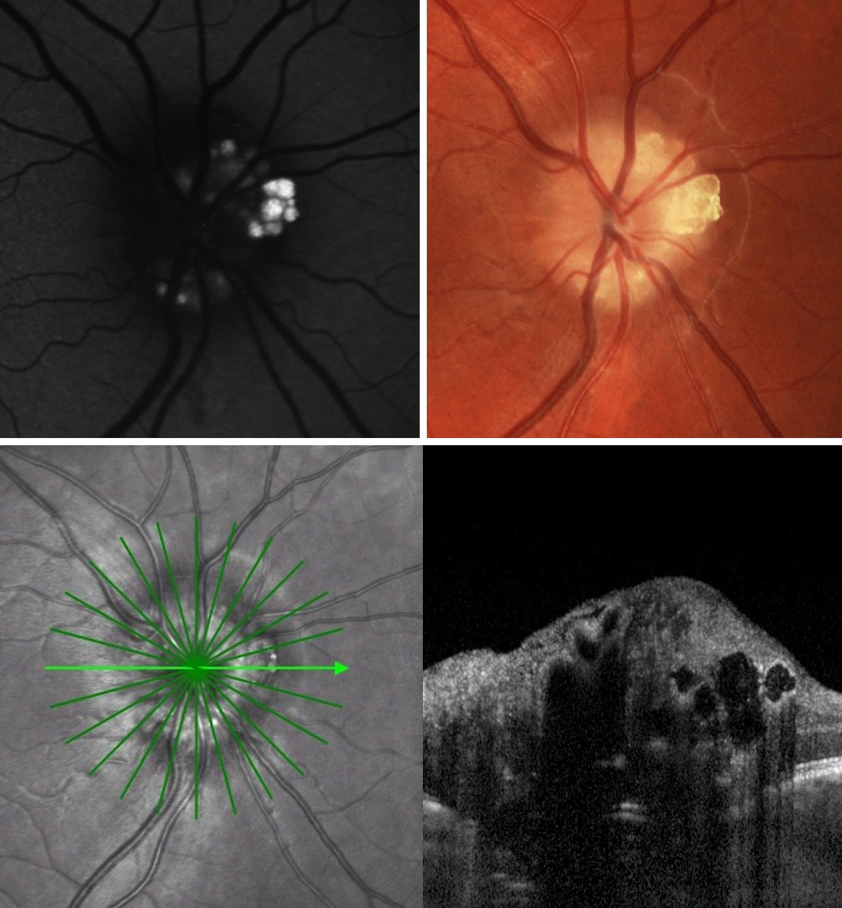 Optic disc drusen