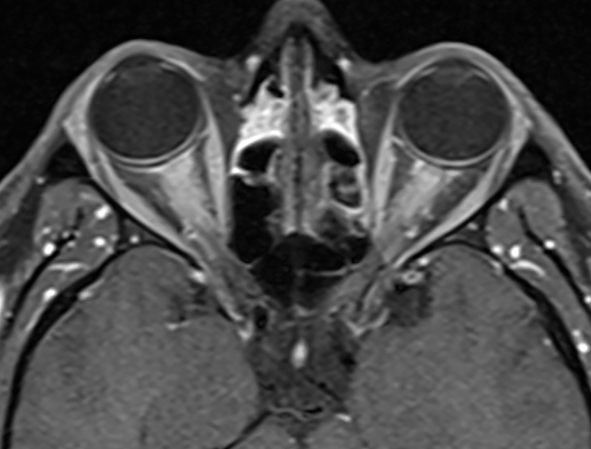 MOG optic neuropathy