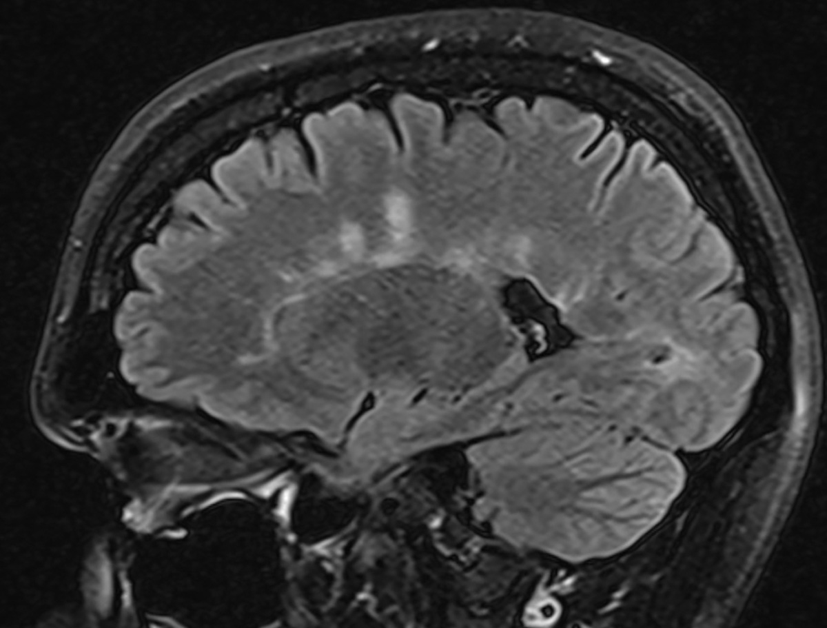 Optic neuritis