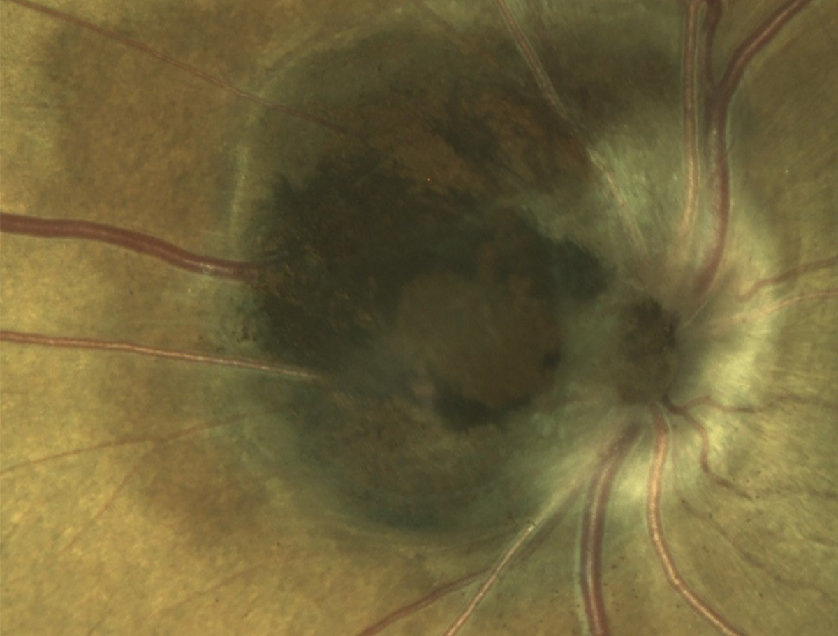 Optic nerve melanocytoma