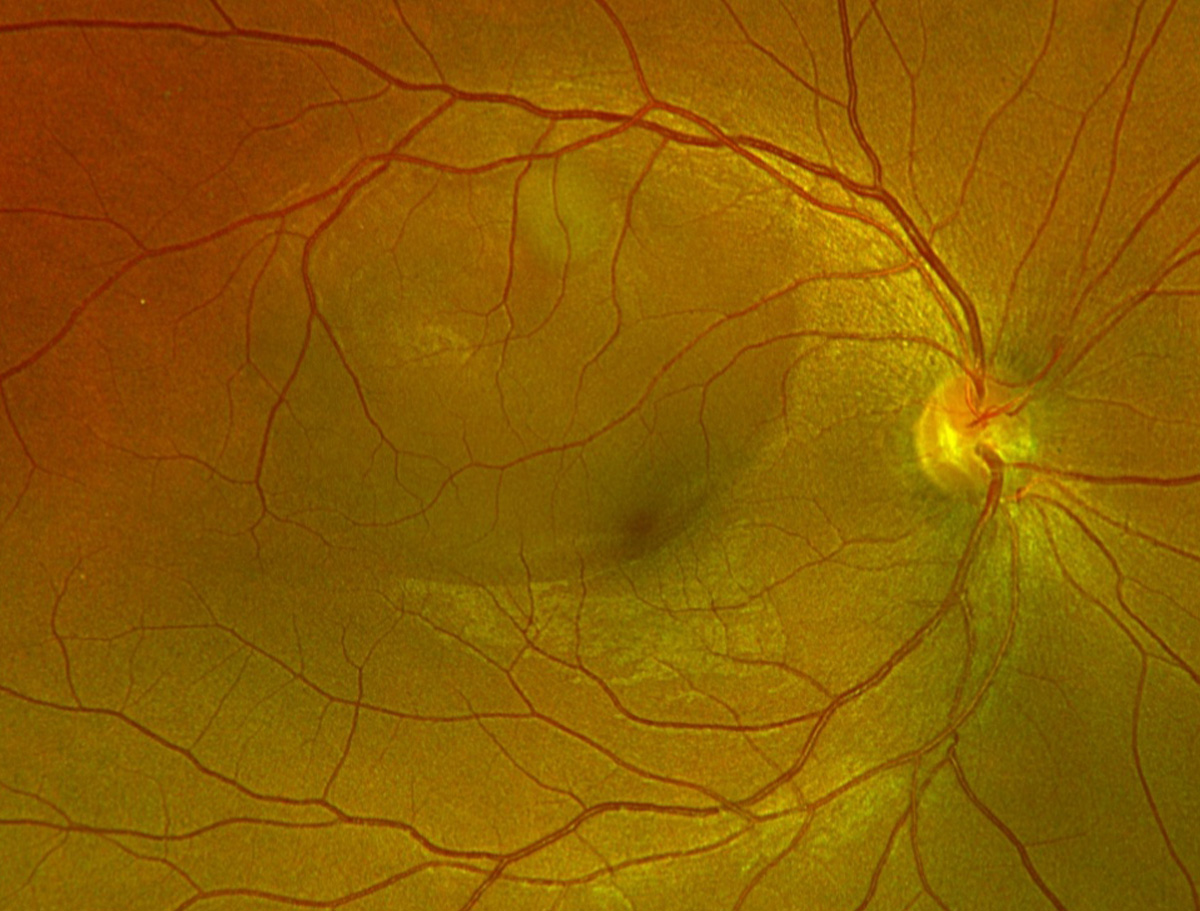 Central serous chorioretinopathy