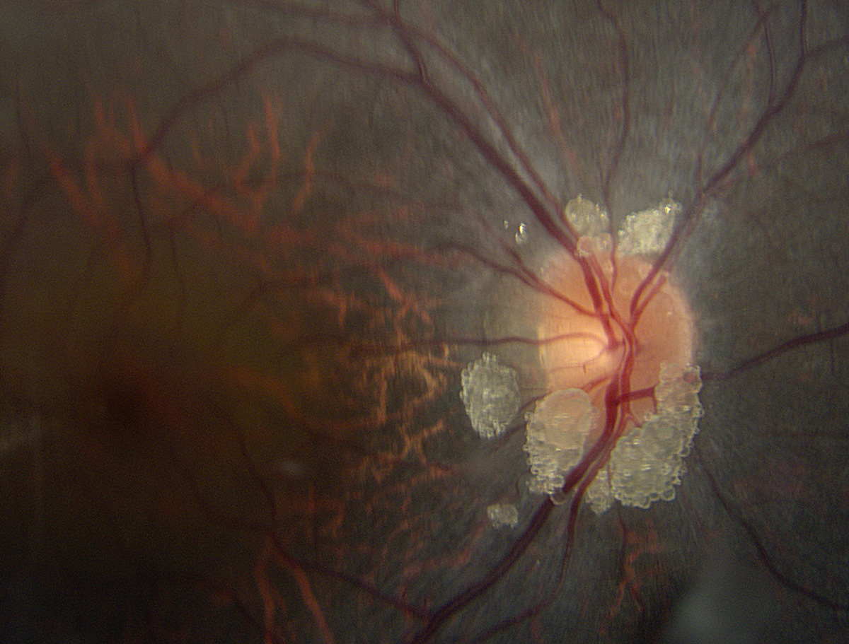 Astrocytic hamartoma