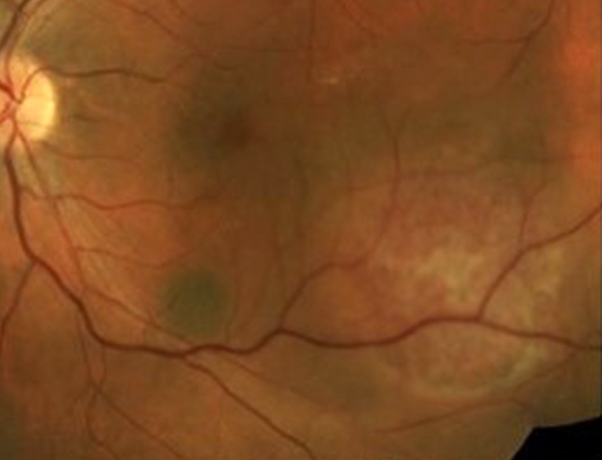 Choroidal hemangioma