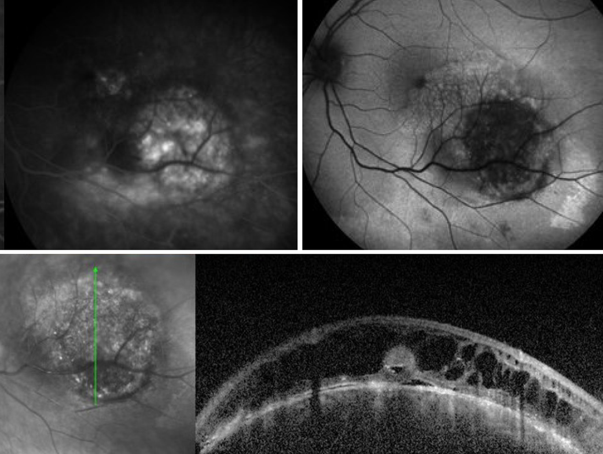 Choroidal hemangioma