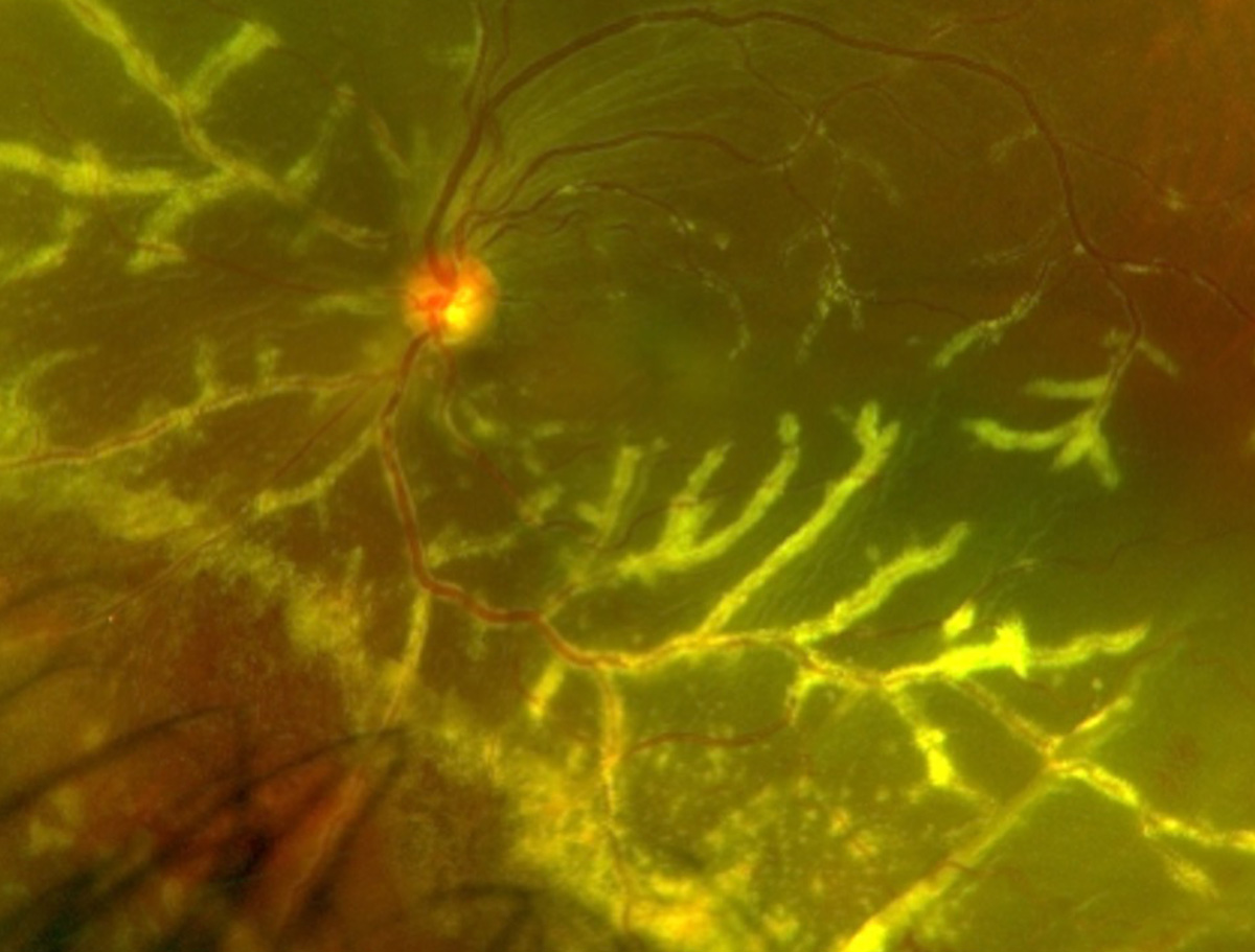 CMV retinitis