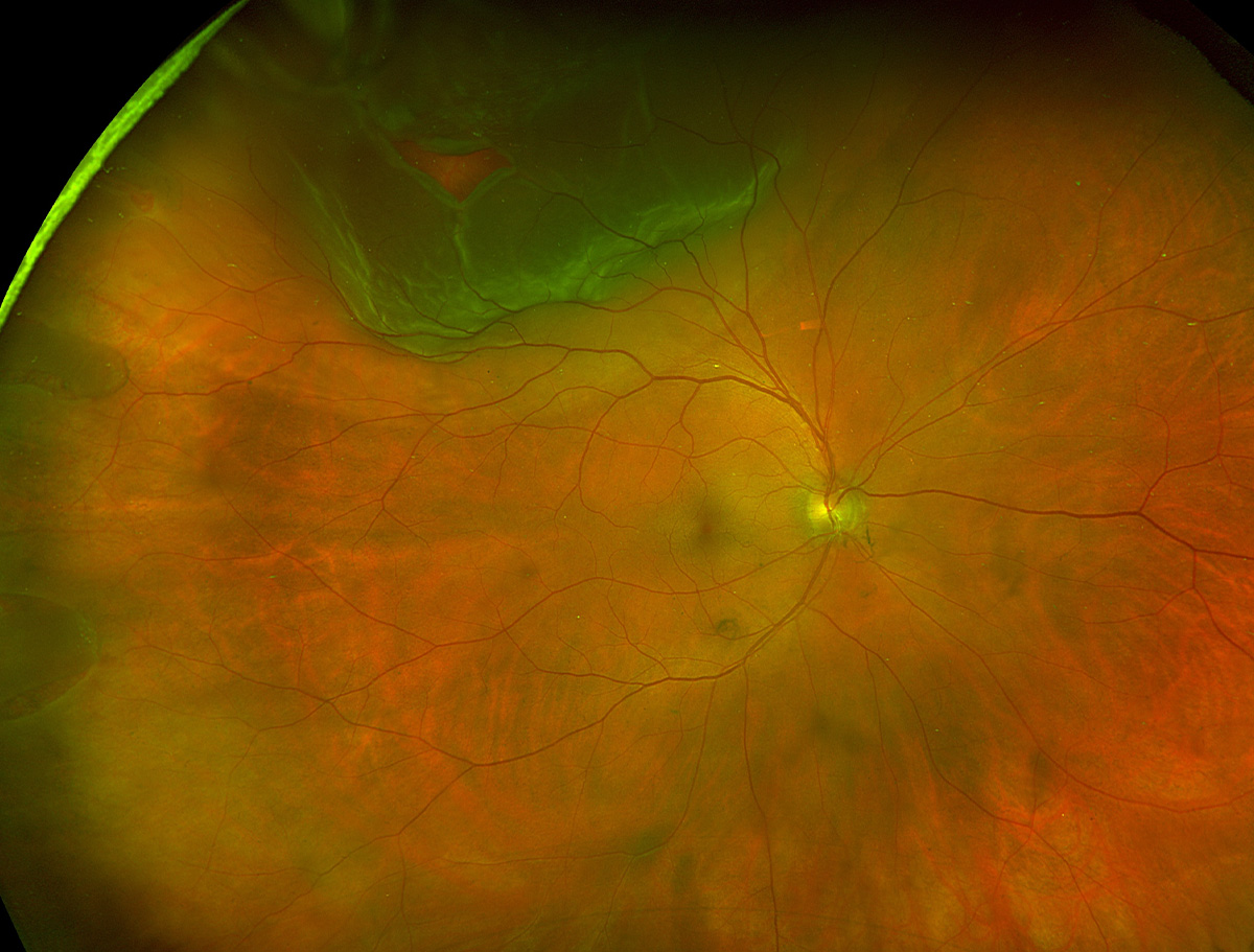 Rhegmatogenous retinal detachment