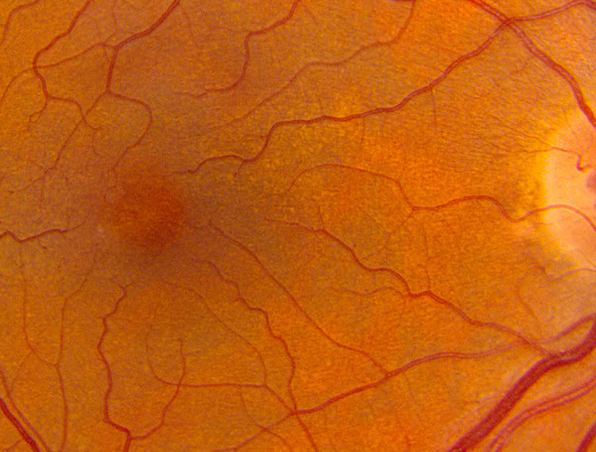 Macular telangiectasia