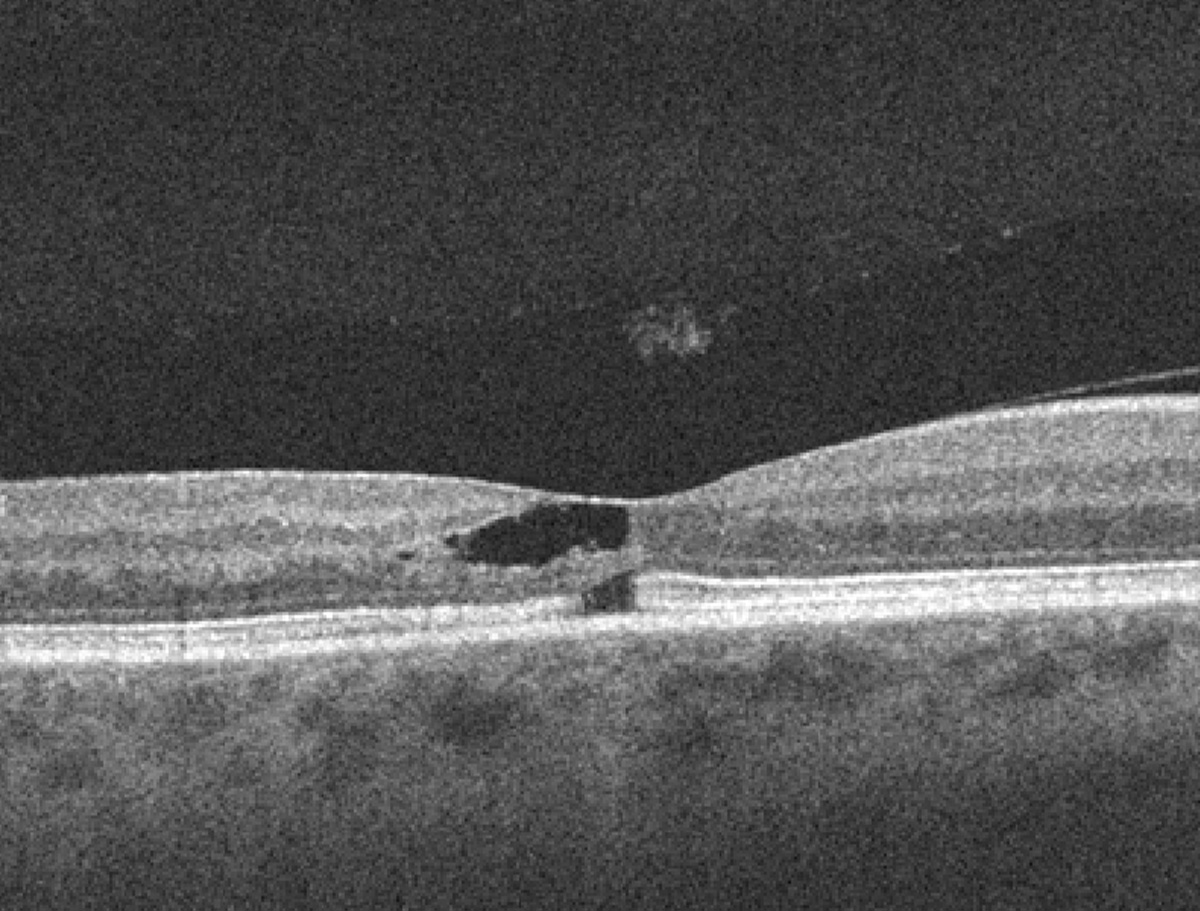 Macular telangiectasia