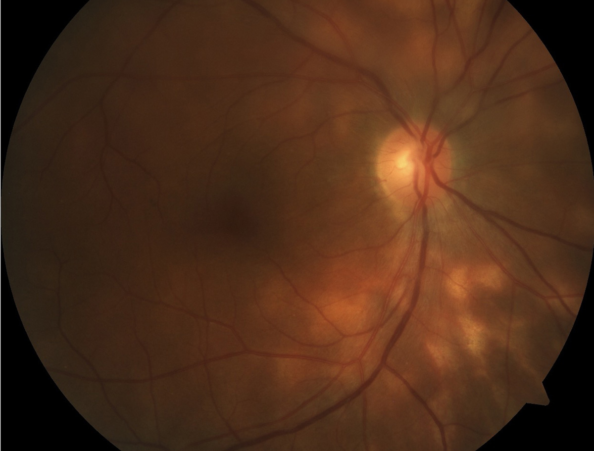 Birdshot retinopathy