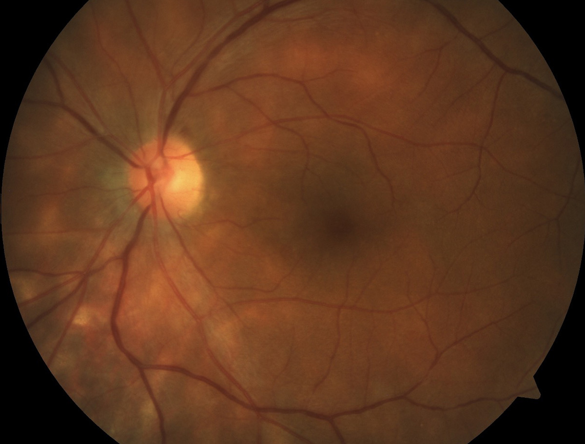 Birdshot retinopathy