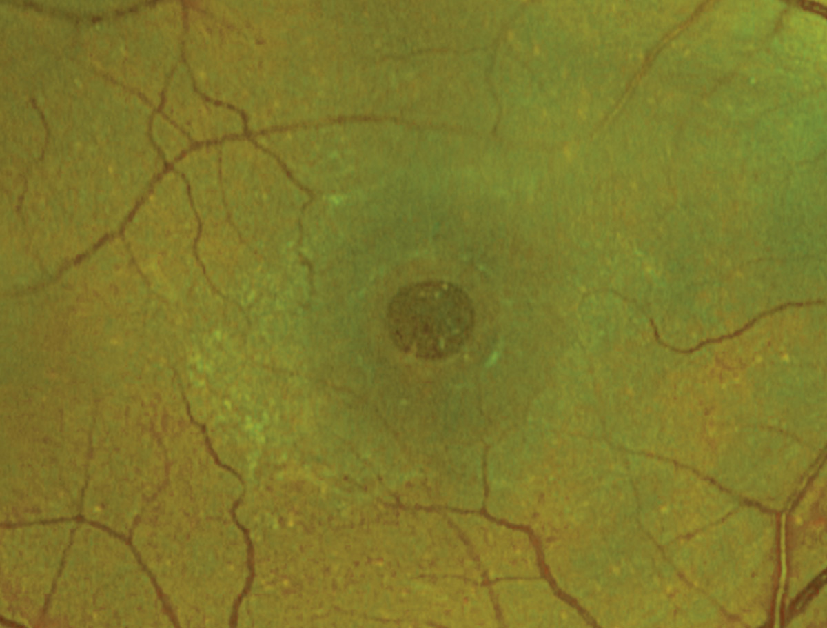 Macular hole