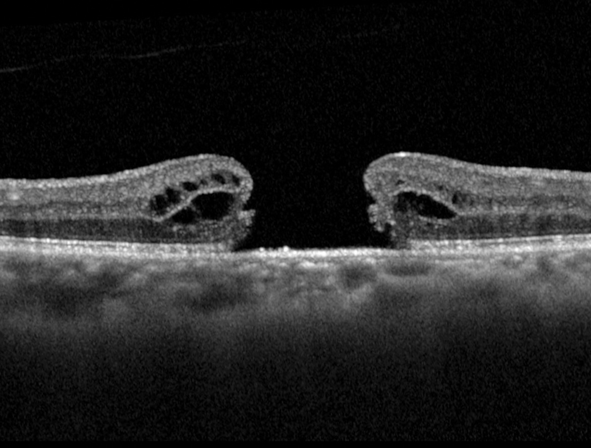 Macular hole