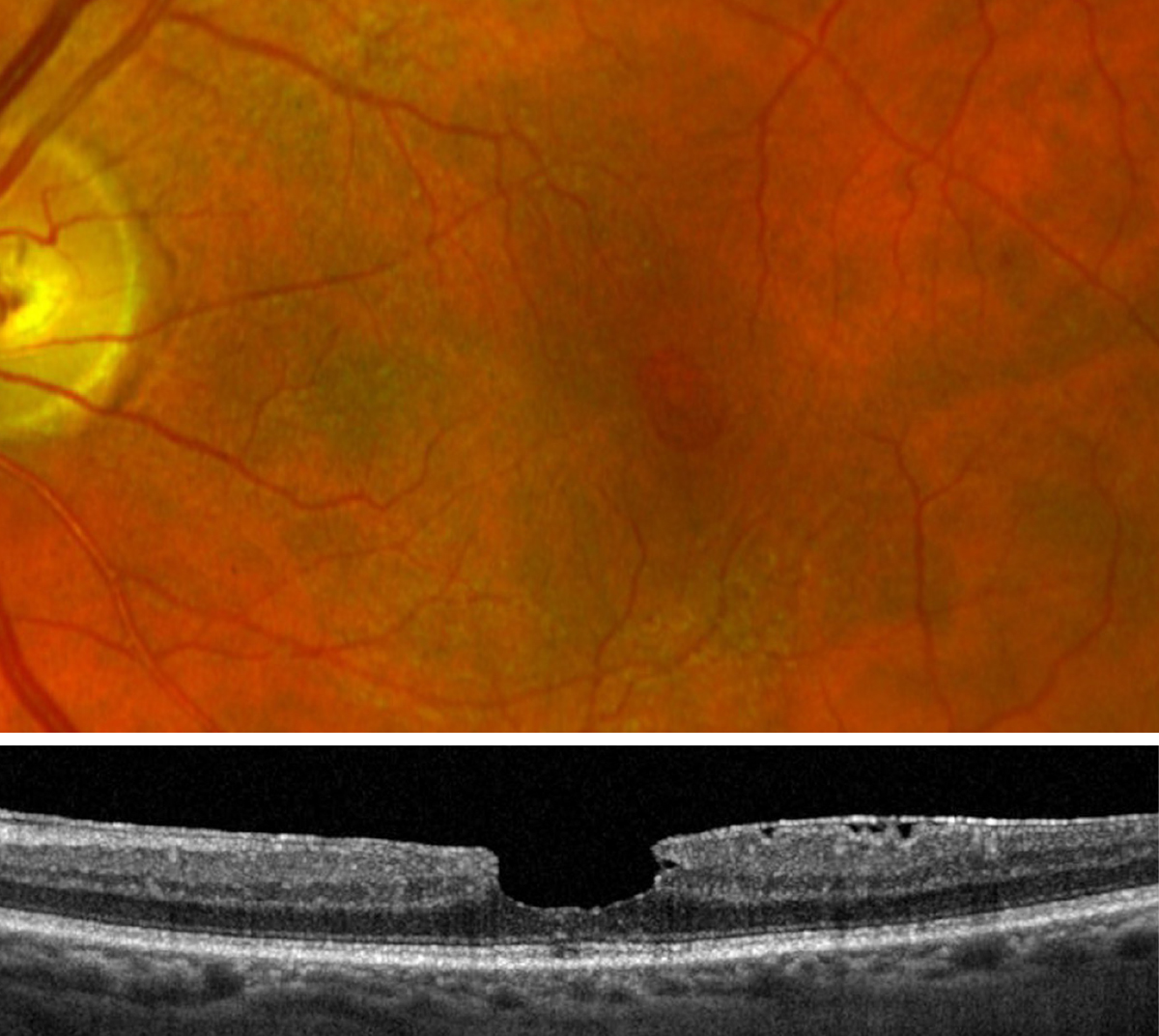 Macular hole