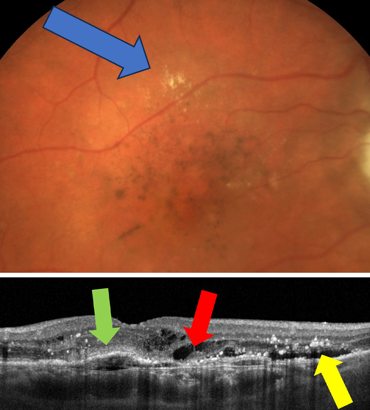 Exudative AMD