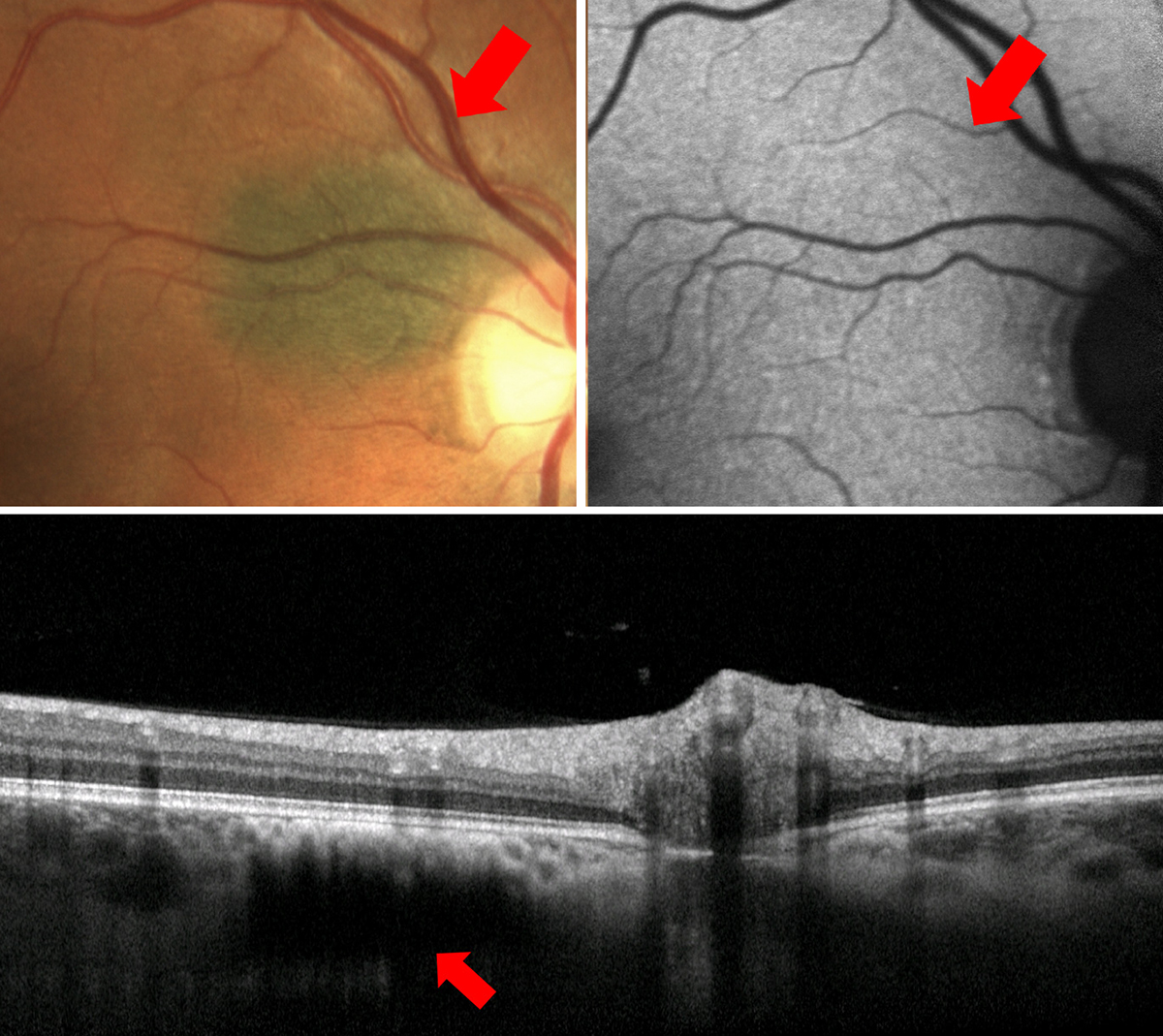 Choroidal nevus