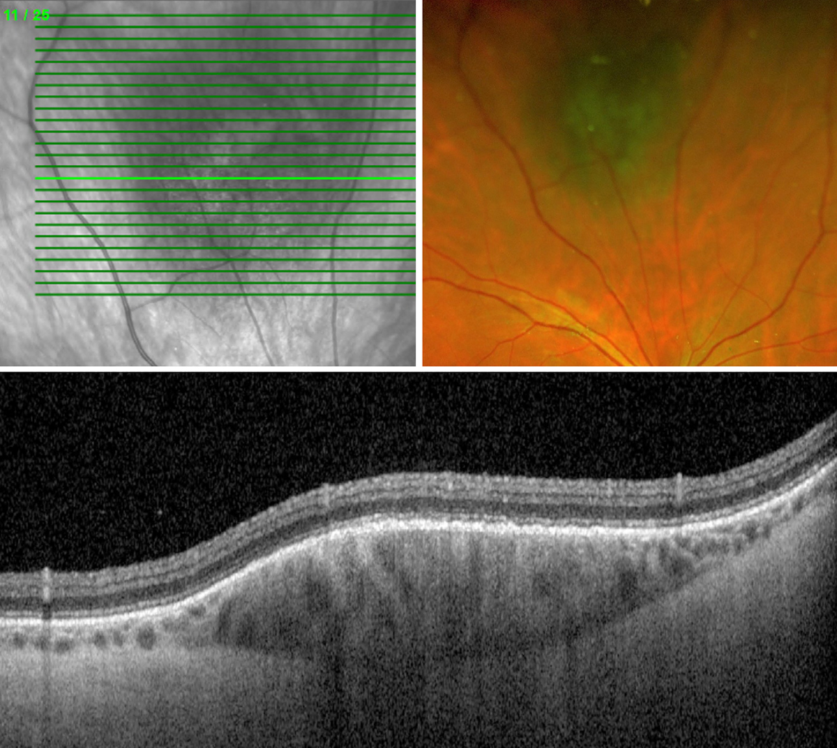 Choroidal nevus