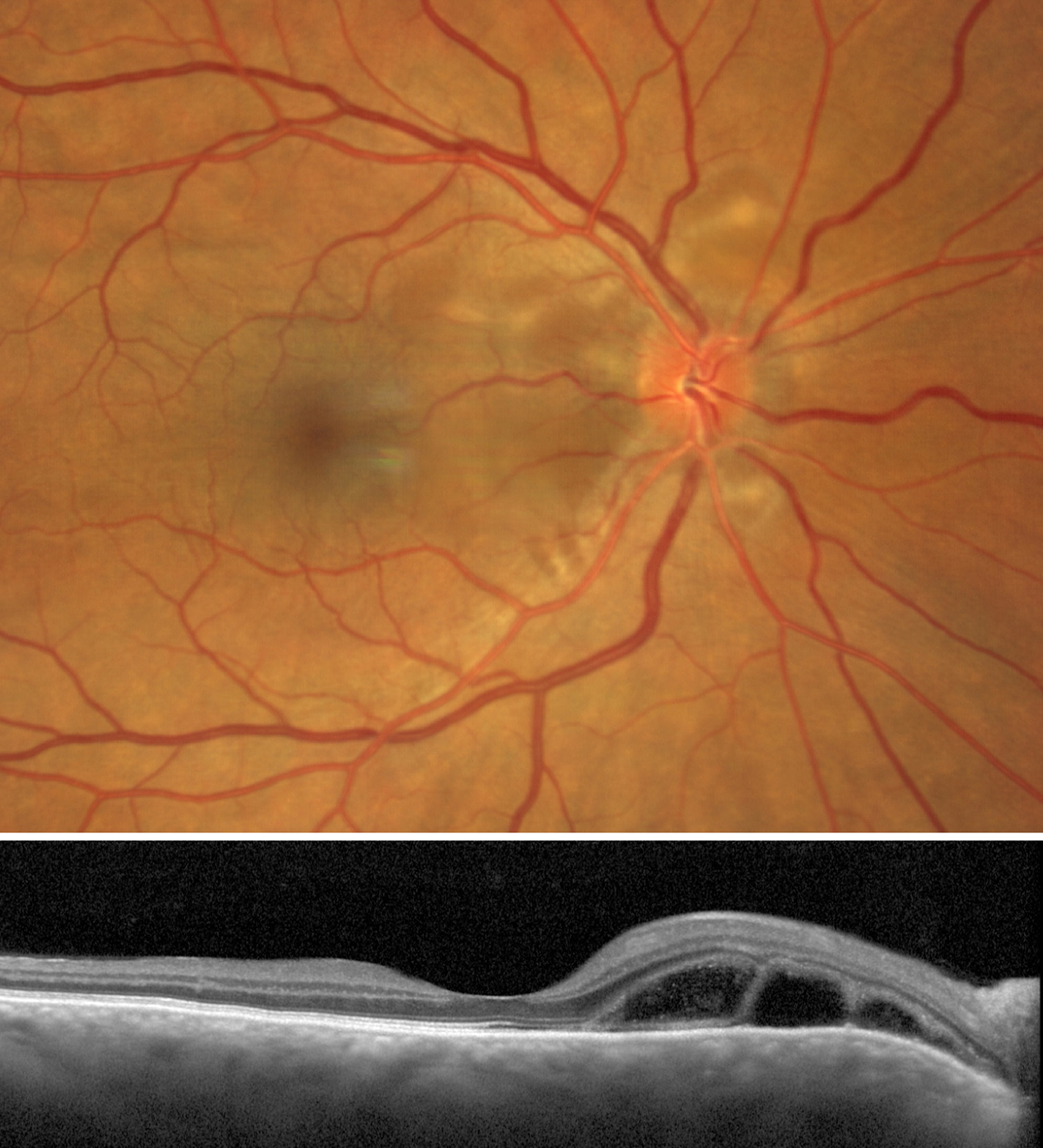 Vogt-Koyanagi-Harada syndrome