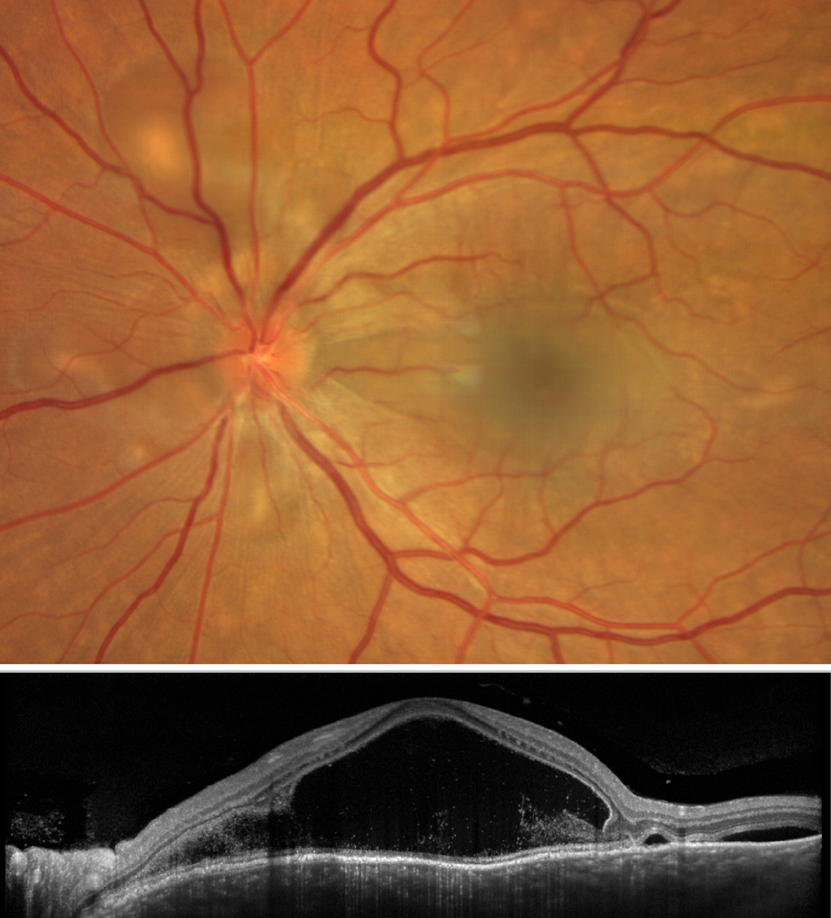 Vogt-Koyanagi-Harada syndrome