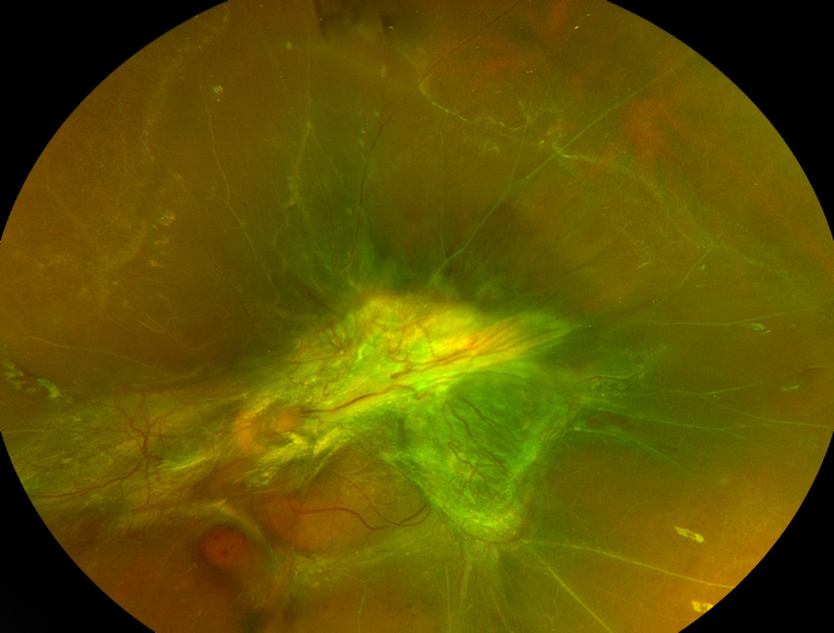 Tractional retinal detachment