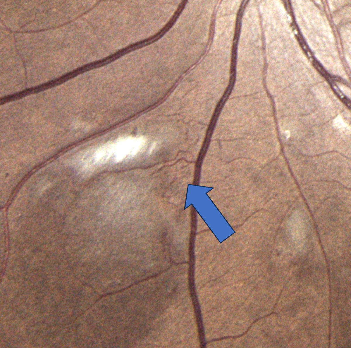 Intraretinal microvascular abnormalities