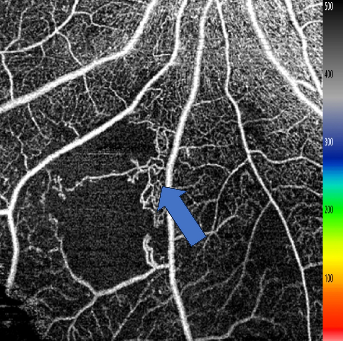 Intraretinal microvascular abnormalities