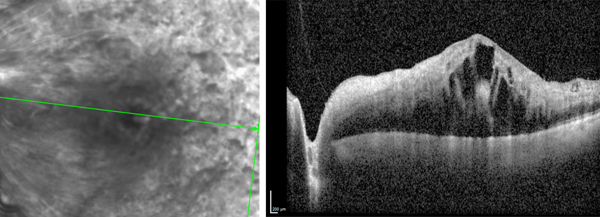 Central retinal vein occlusion