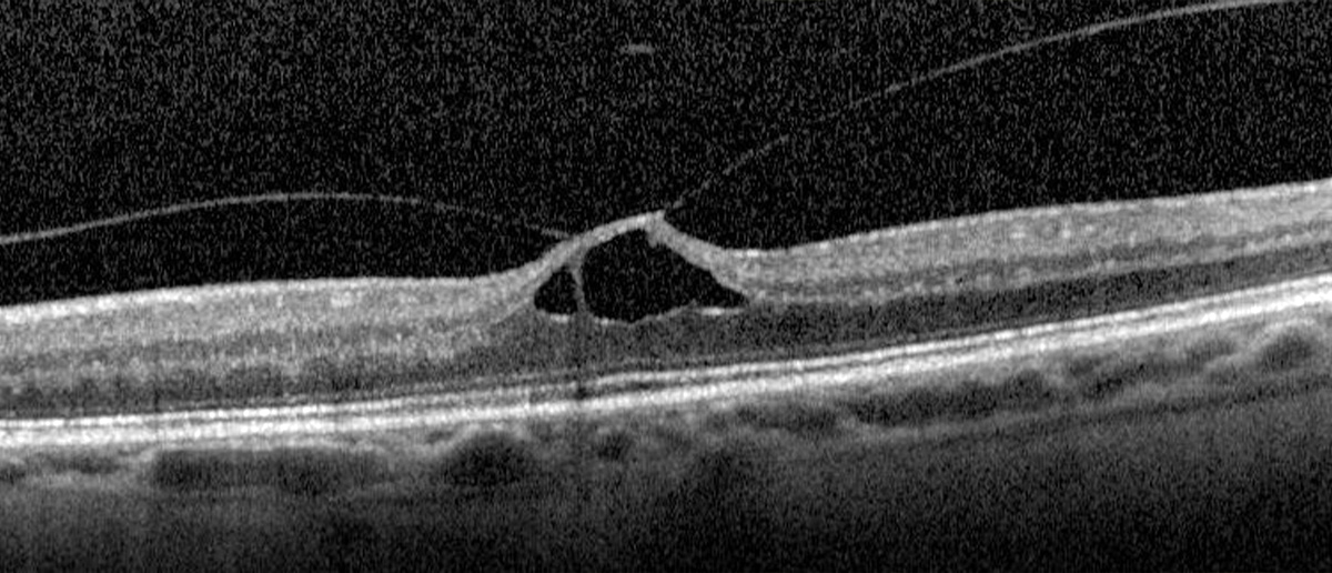 Vitreomacular traction