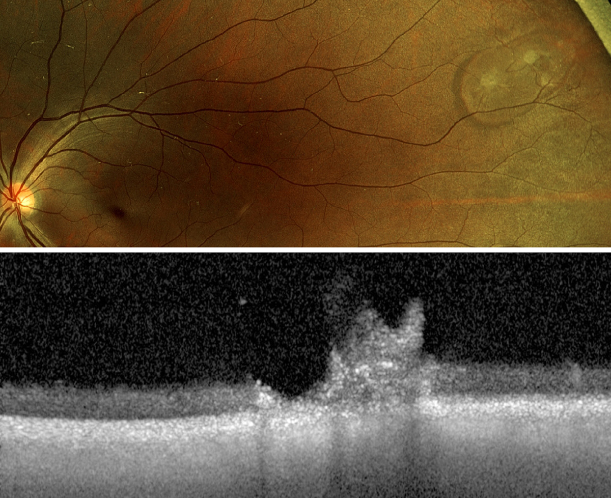 Retinal tufts