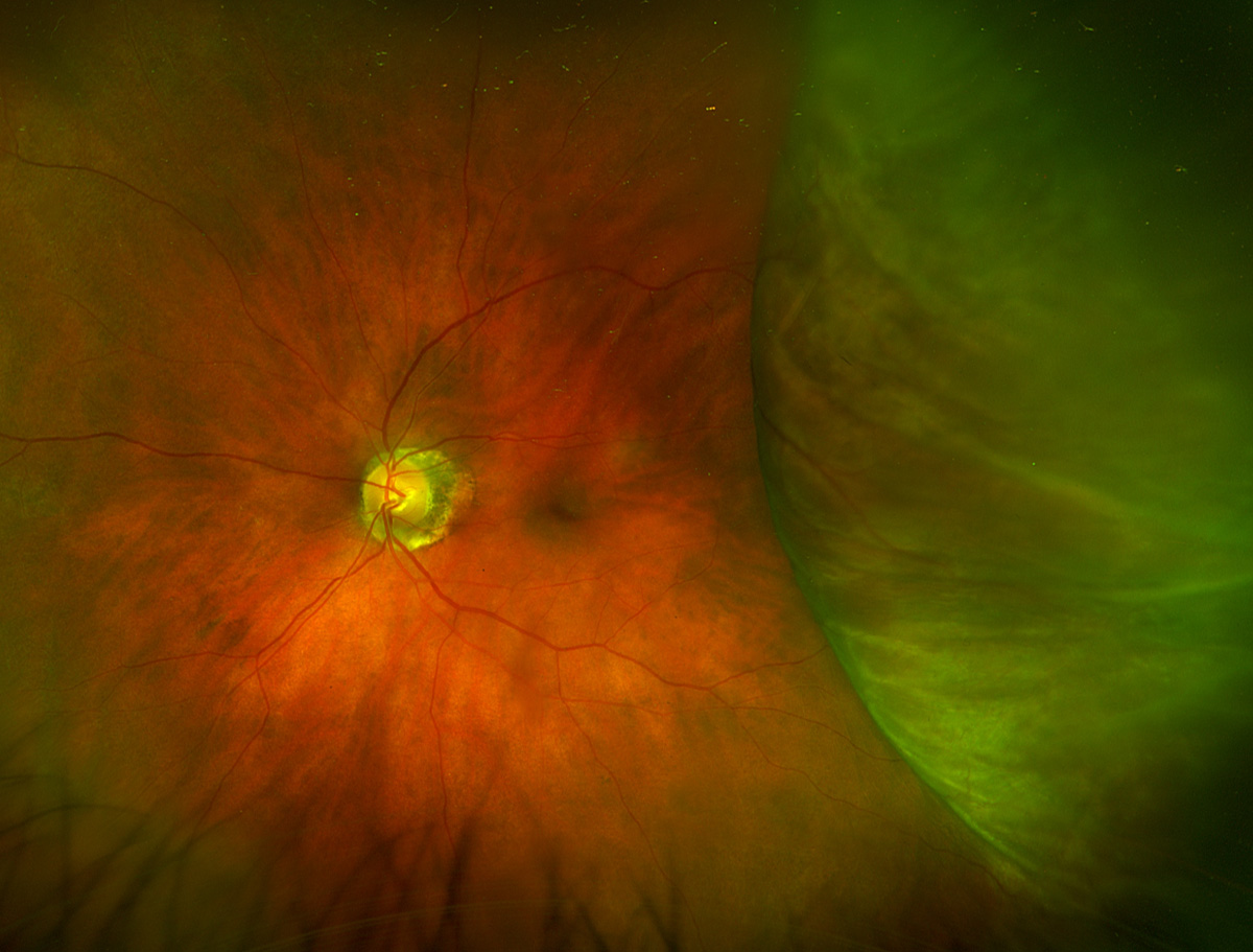 Choroidal effusion