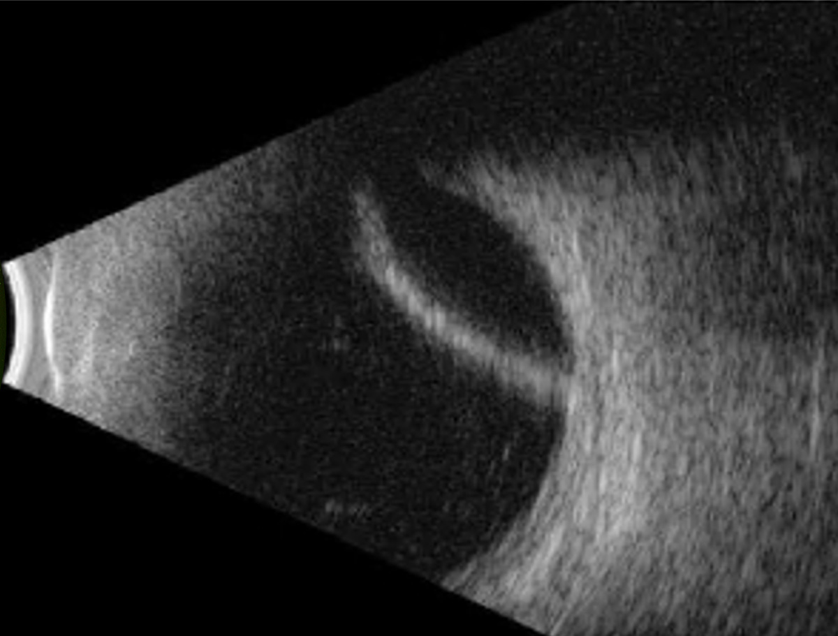 Choroidal effusion