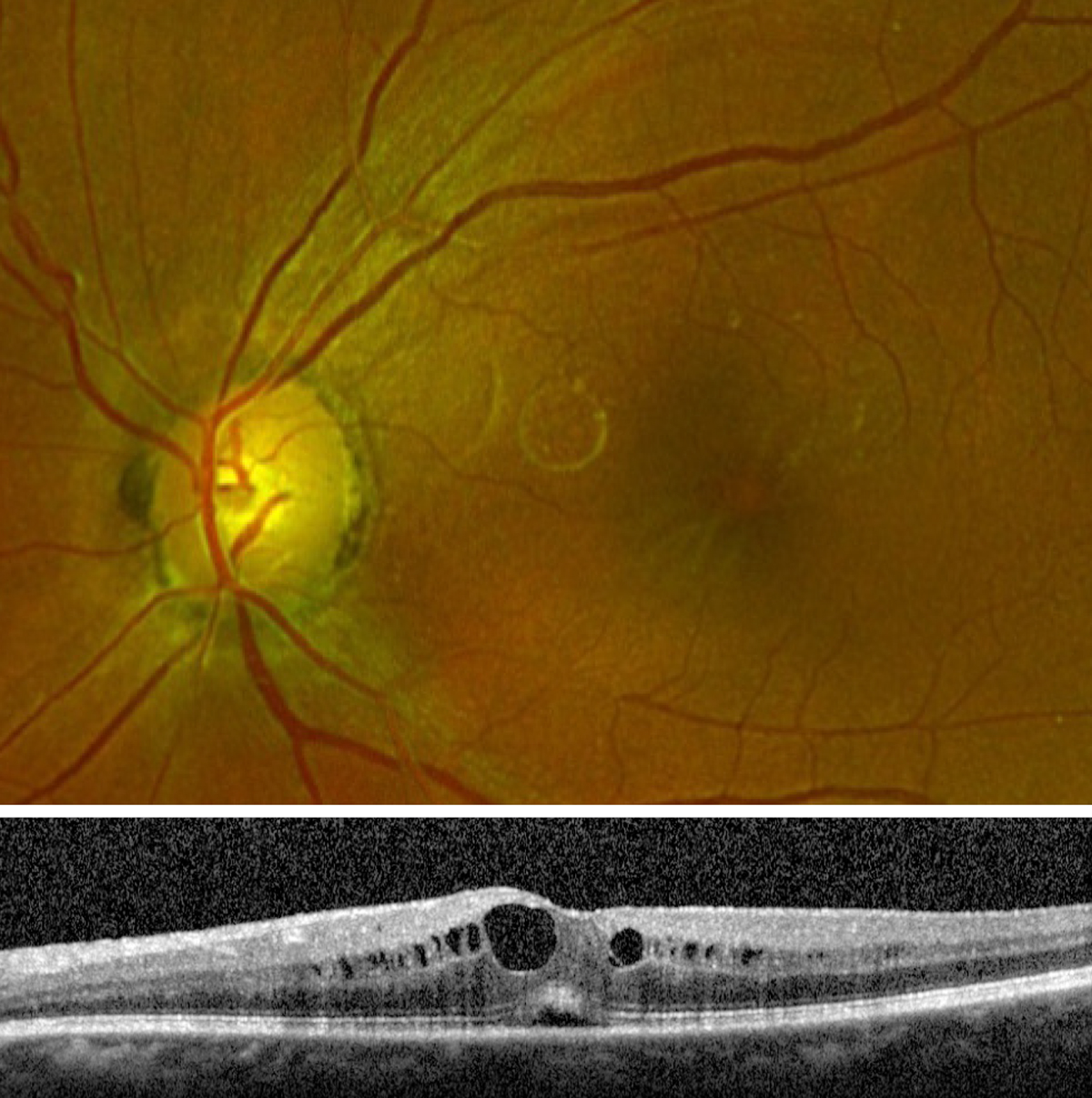 Cystoid macular edema