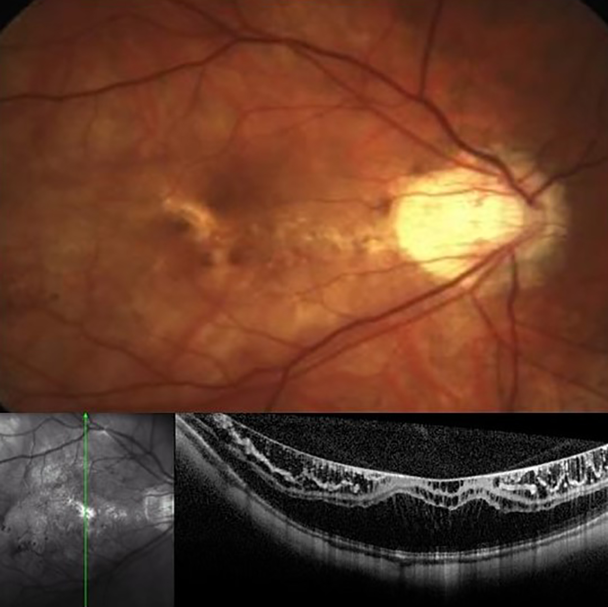 Myopic tractional maculopathy