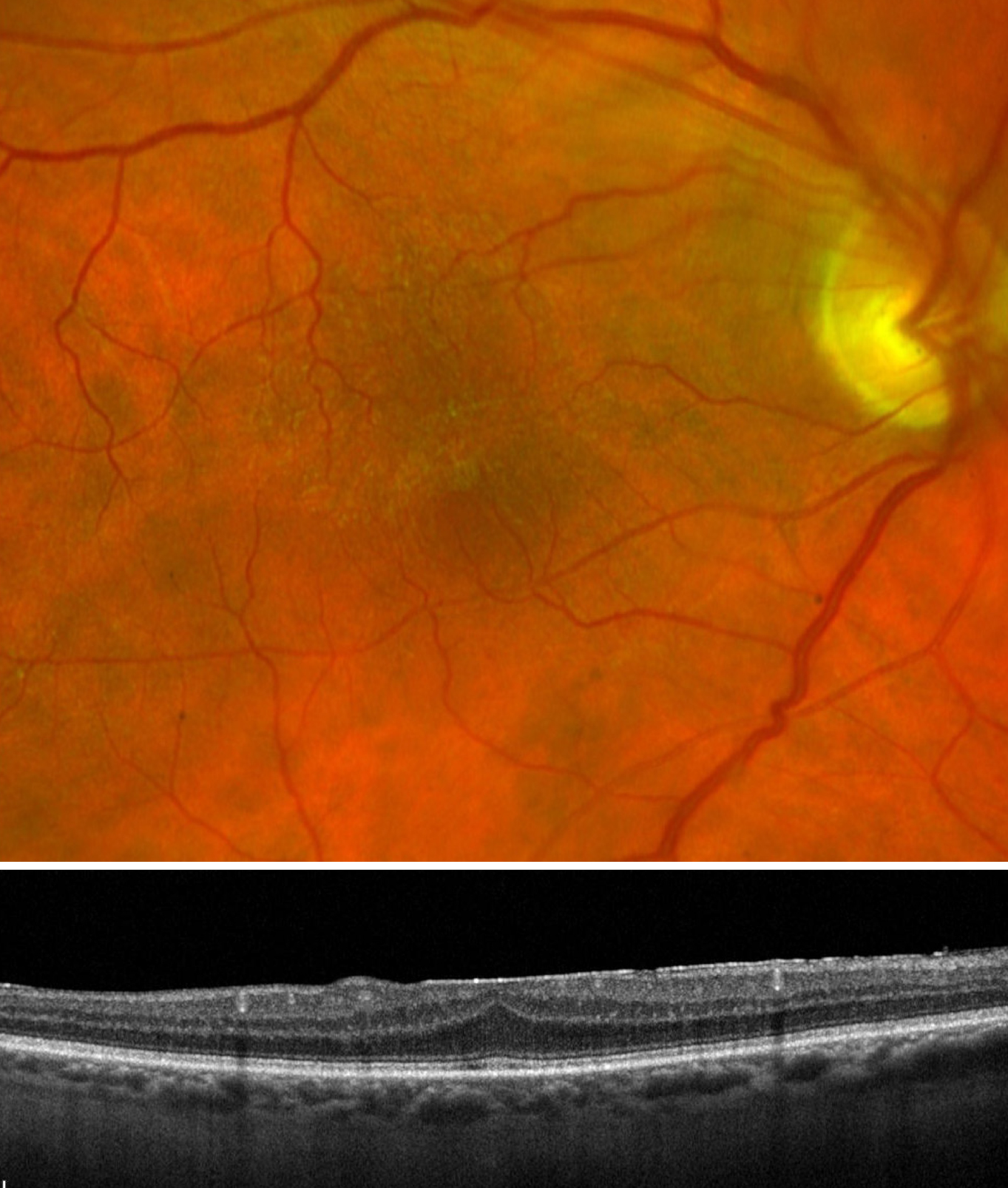 Epiretinal membrane