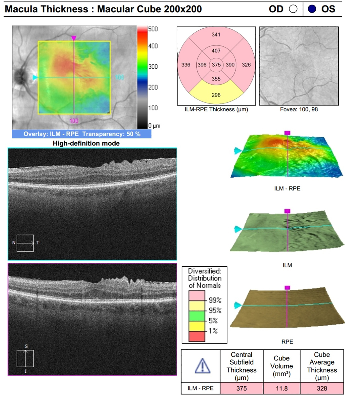 Epiretinal membrane