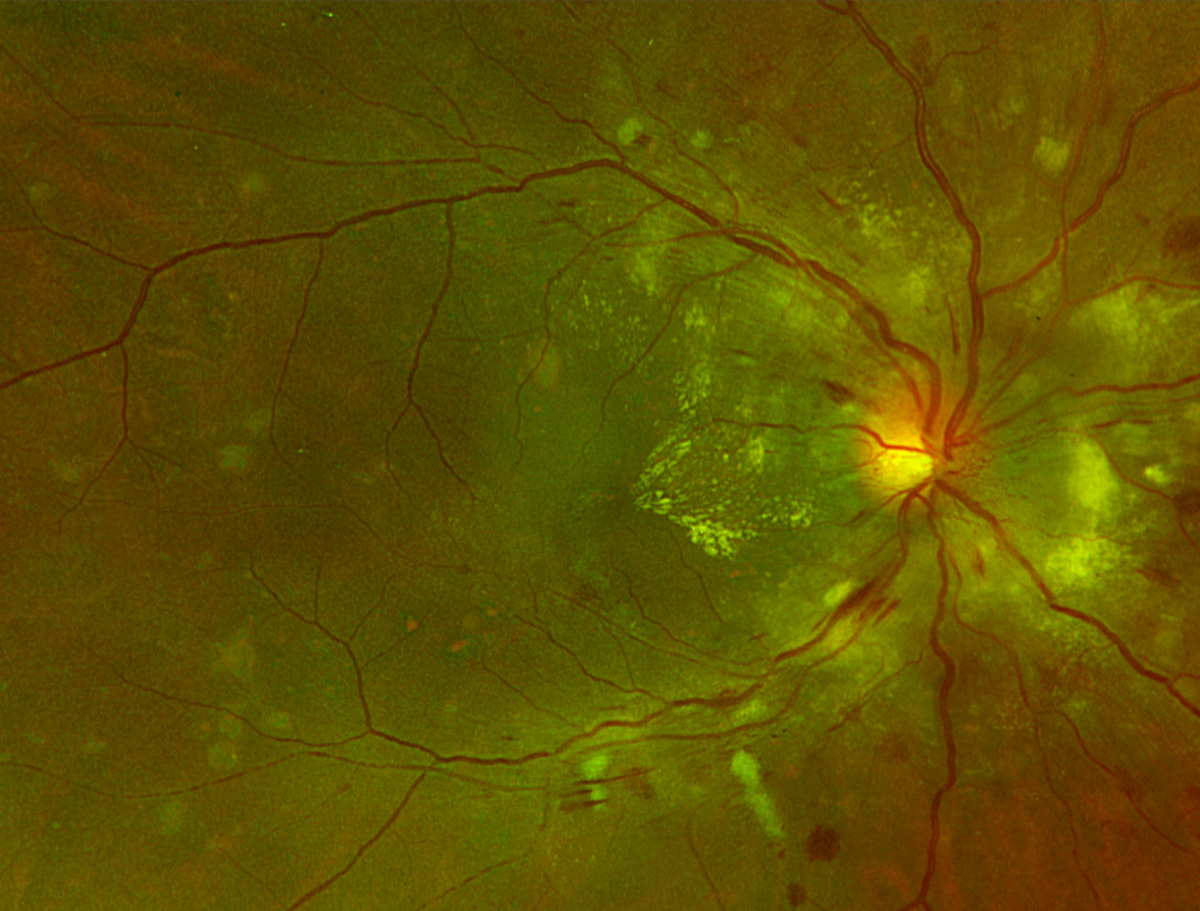 Hypertensive retinopathy