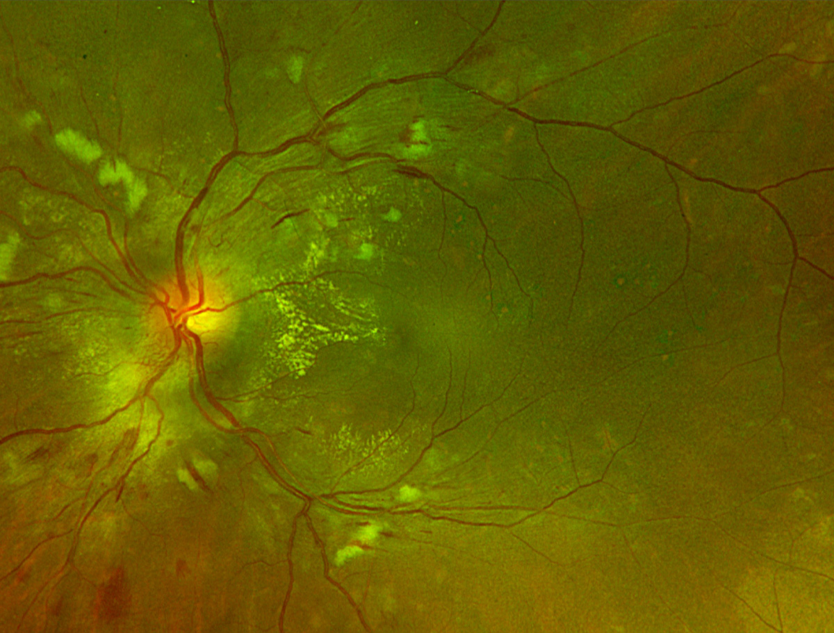 Hypertensive retinopathy