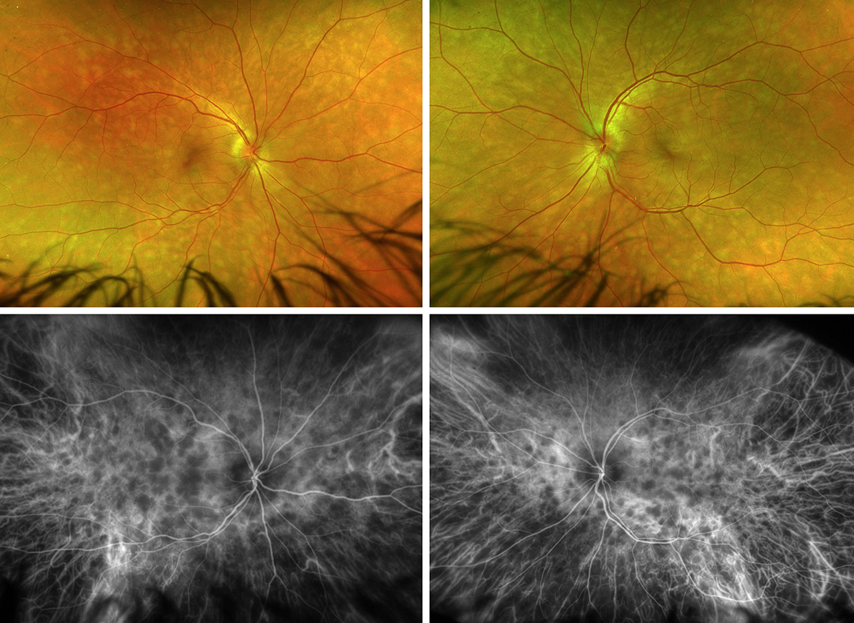 Panuveitis