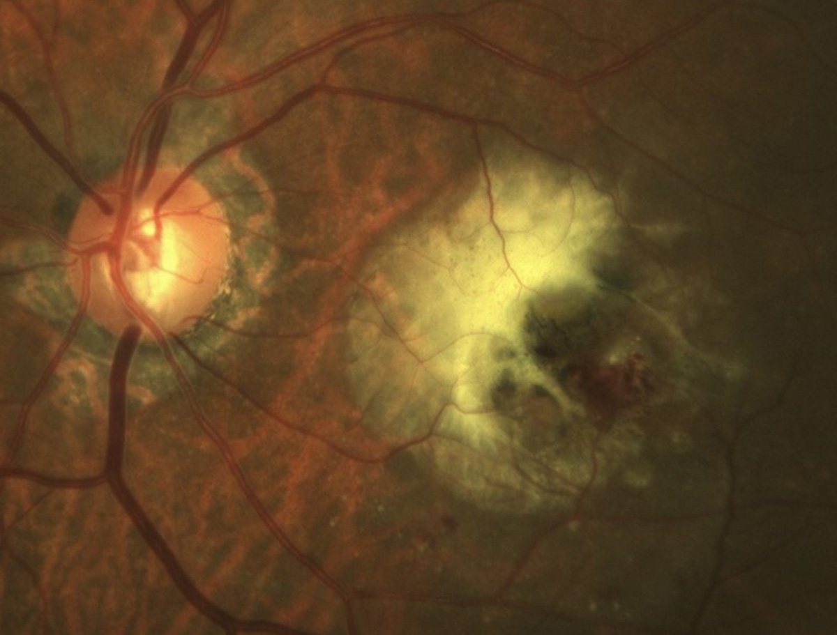 Retinal angiomatous proliferation