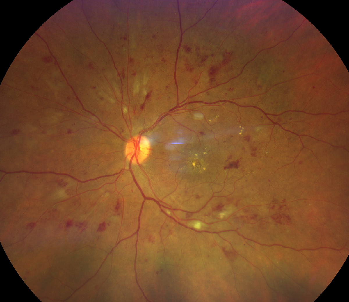 Nonproliferative diabetic retinopathy