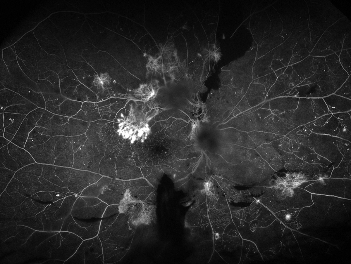 Proliferative diabetic retinopathy