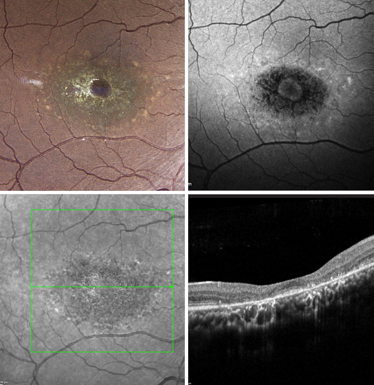 Stargardt's disease