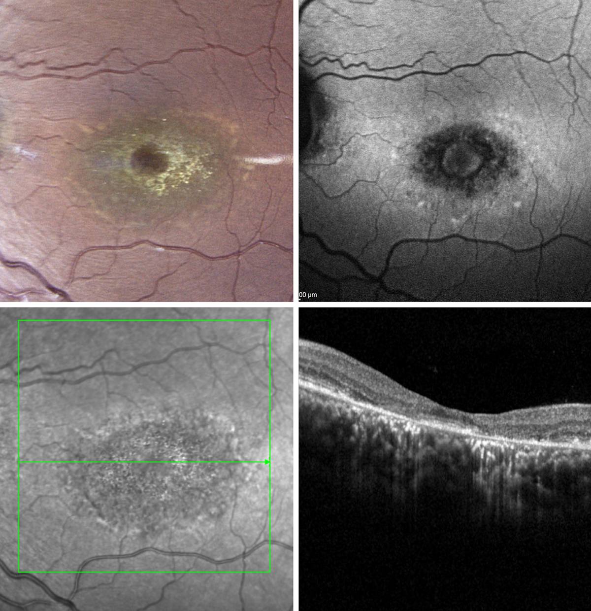 Stargardt's disease