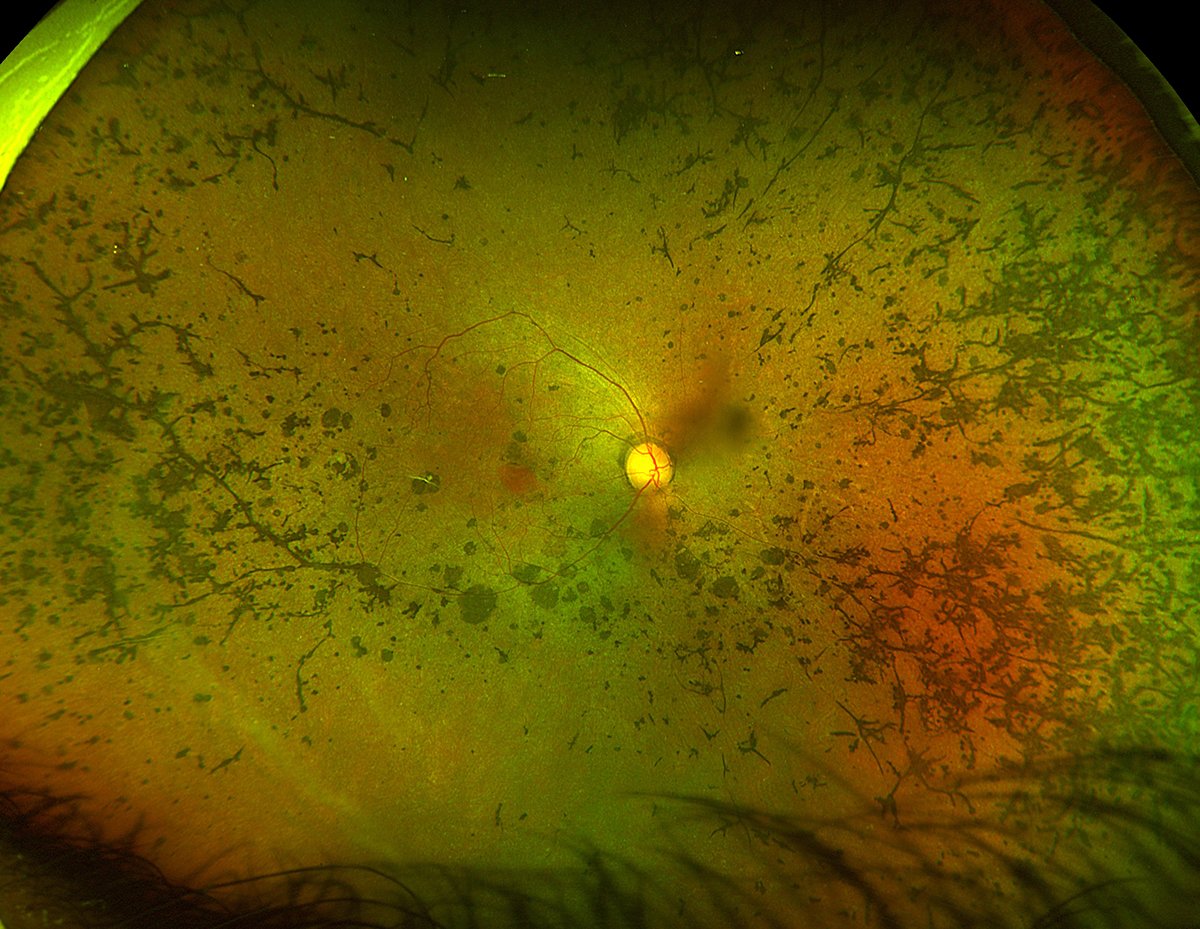 Retinitis pigmentosa