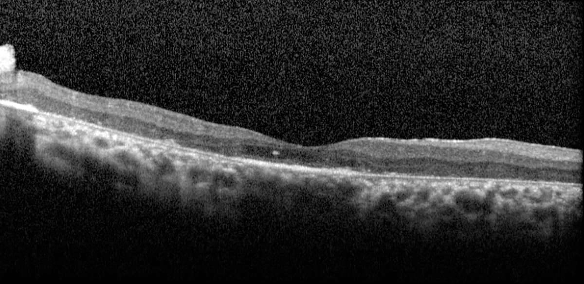 Retinitis pigmentosa