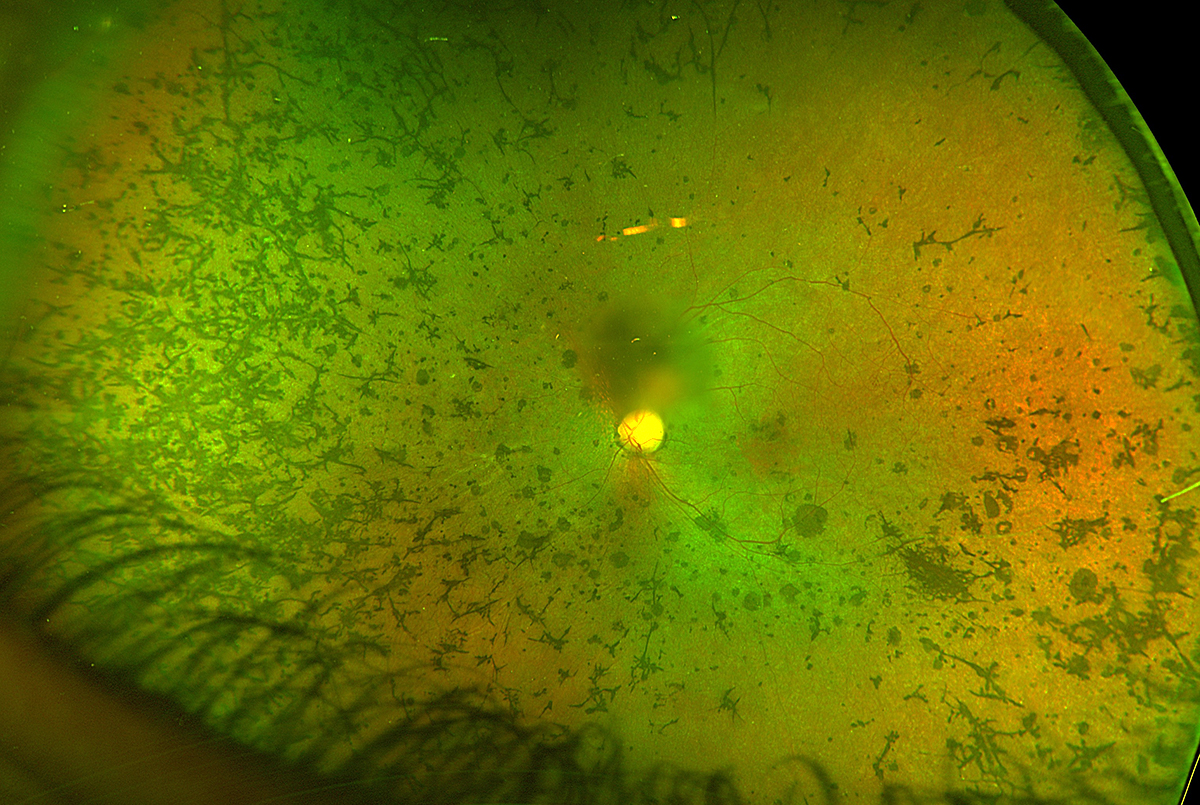 Retinitis pigmentosa