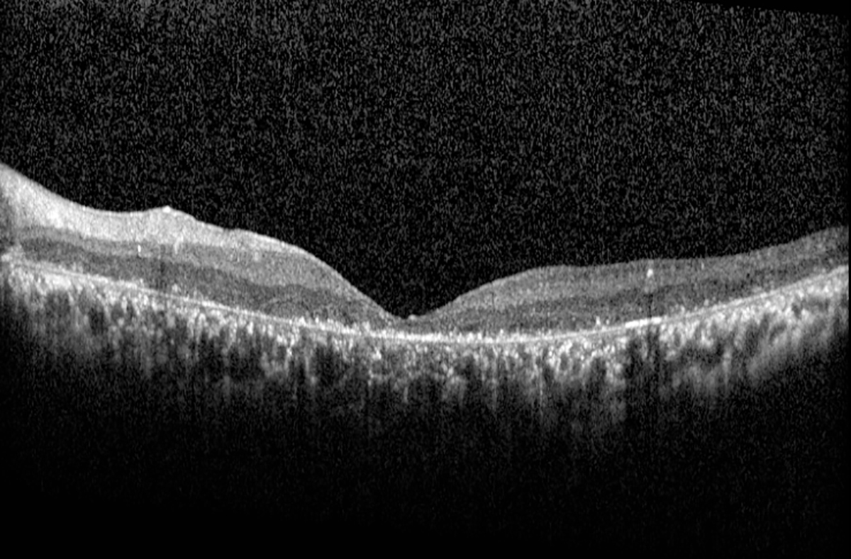 Retinitis pigmentosa