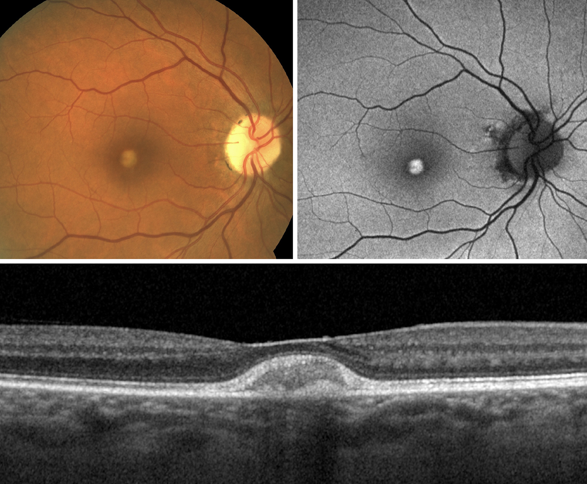 Vitelliform dystrophy