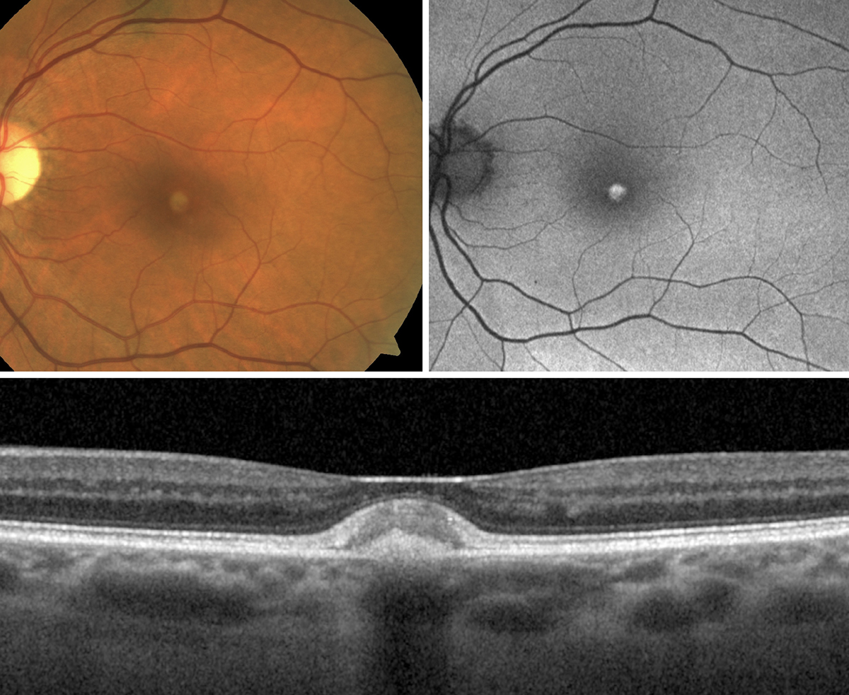 Vitelliform dystrophy